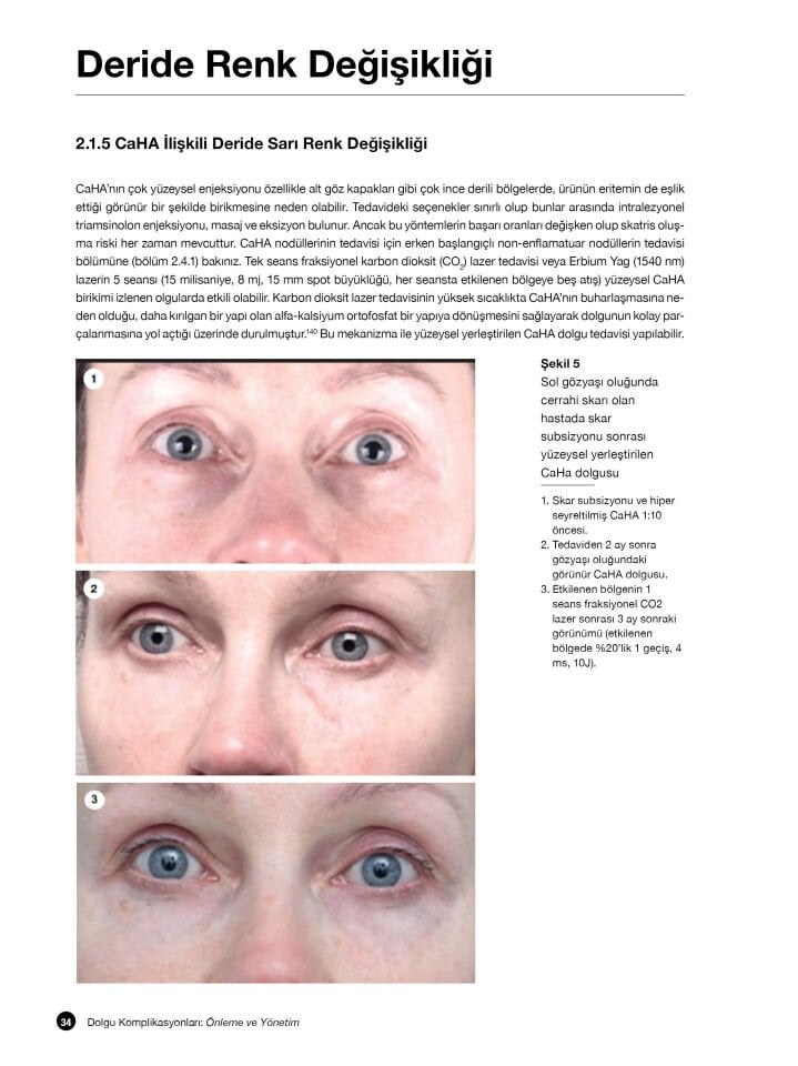 Dolgu Komplikasyonları: Önleme ve Yönetim Videolu Kitap