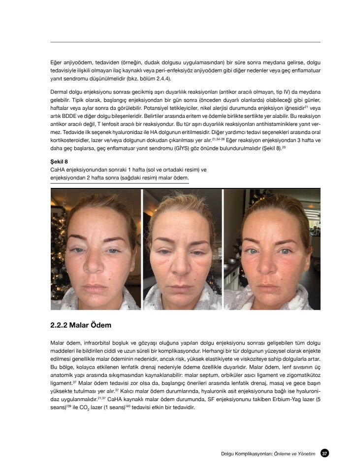 Dolgu Komplikasyonları: Önleme ve Yönetim Videolu Kitap