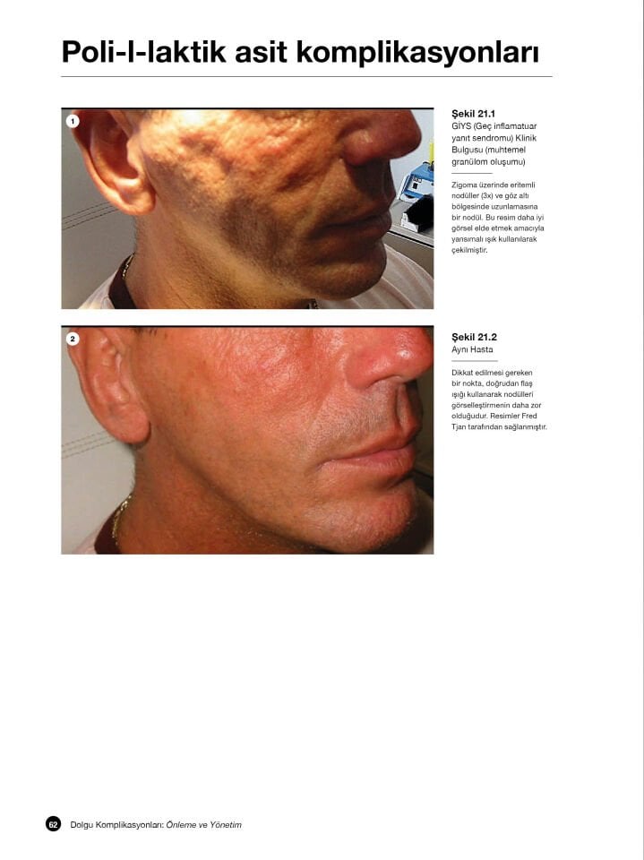 Dolgu Komplikasyonları: Önleme ve Yönetim Videolu Kitap