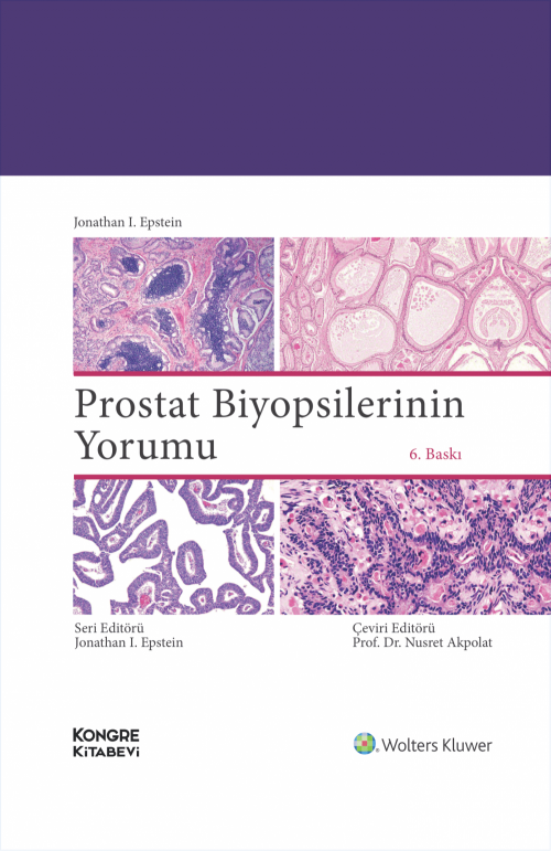 Prostat Biyopsilerinin Yorumu